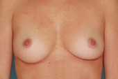 Patient # 97467 Before Photo # 1